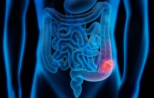 A Temporary Colostomy Is Performed On The Client With Colon Cancer. The ...